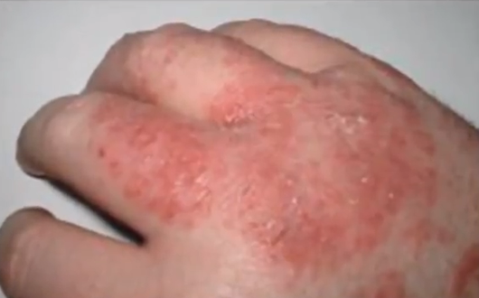 severe eczema on hands