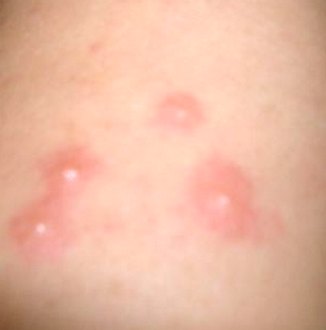 Insect Bite - Identification, Pictures of Swelling and Blisters