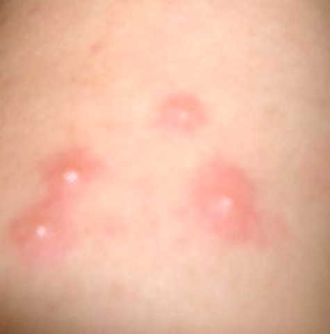 Skin Rash: 59 Pictures, Causes, Treatments - Healthline