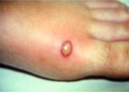 My bug bite is now a blister. How should I treat it? - WebMD
