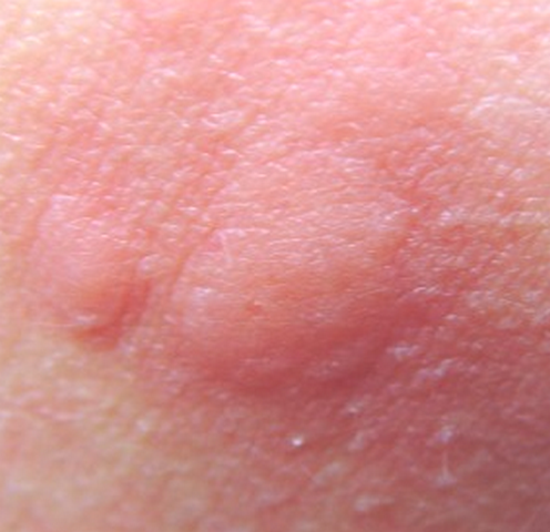 Identifying Bug Bites: 10 Common Types, Pictures, Symptoms