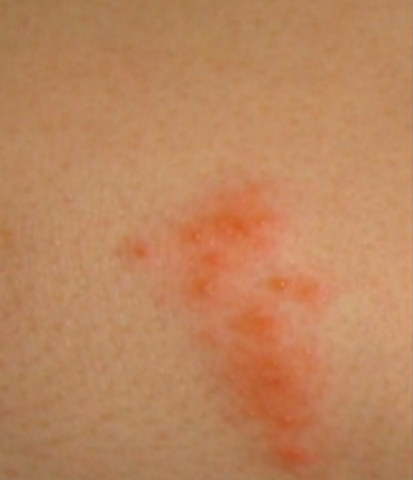 Shingles Symptoms - Mayo Clinic