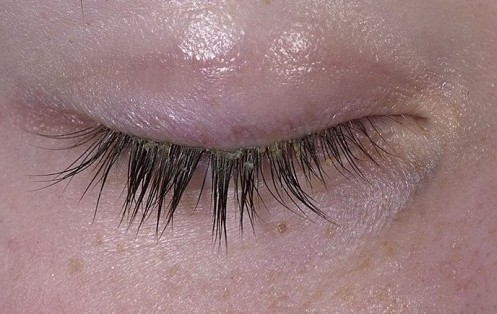 dry skin on eyelid