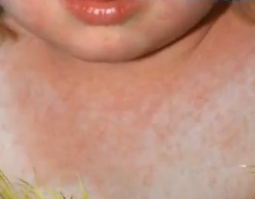 scarlet fever rash #11