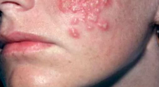 Picture of Erythema Infectiosum - WebMD