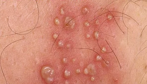 Rash bumps anus hiv