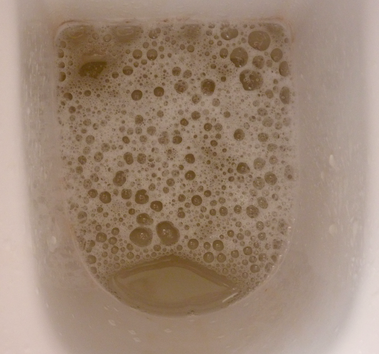 Causes of Foamy Urine in Men