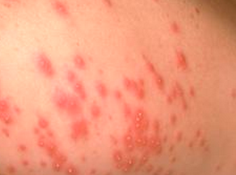 Lower Leg Rash - Dermatology - MedHelp