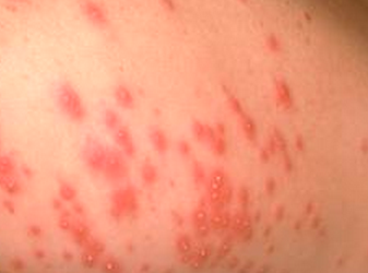 Hot Tub Rash Pictures – Itchy Skin Rash