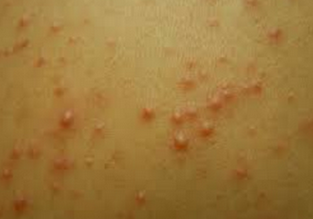 Hot Tub Rash Pictures Treatment Symptoms Causes