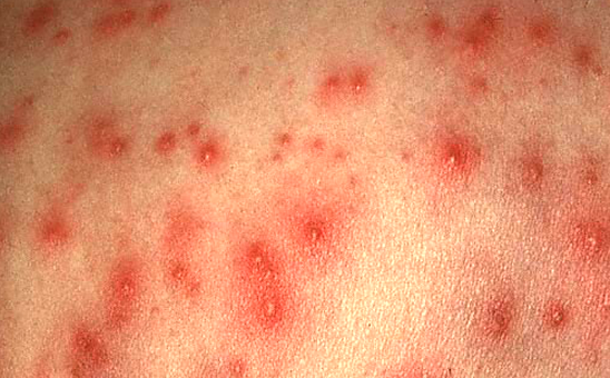 diabetic rash pictures #10