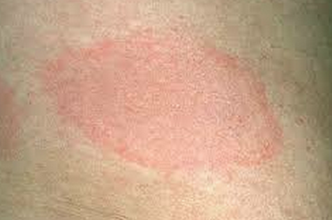 Skin Rashes & Other Skin Problems - familydoctor.org