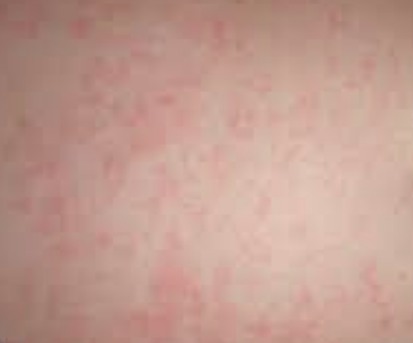 symptoms-of-mono-rash-infectious-mononucleosis-causes-treatment