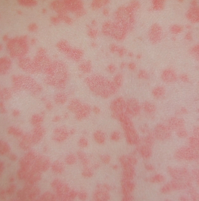 mononucleosis rash