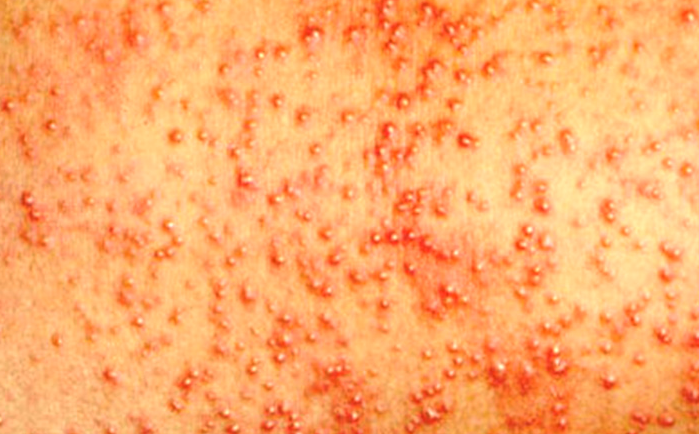 Heat Rash Pictures, Symptoms, Causes, & Treatments