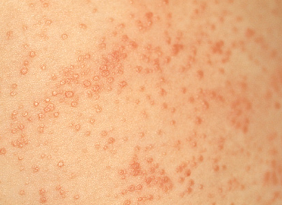 Picture of Heat Rash - WebMD