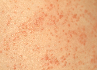 Heat Rash: Causes, Symptoms, Treatment & Pictures