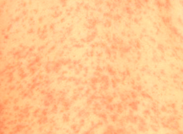 Prickly Heat Rash - WebMD