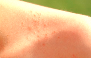 Underarm (Armpit) Rash - Pictures, Symptoms, Causes and ...