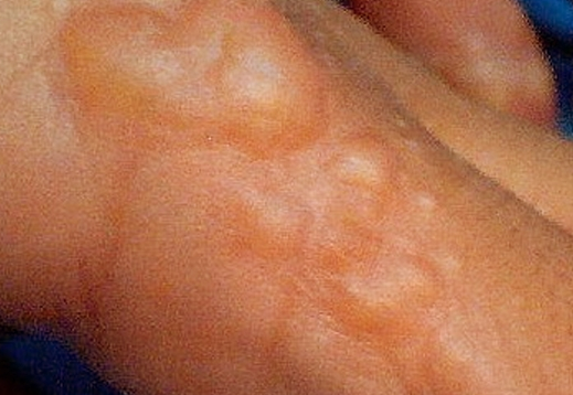 Eczema (Atopic Dermatitis) Causes, Symptoms, Treatment