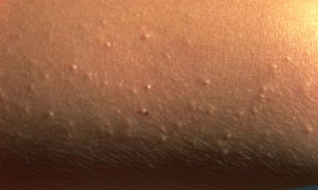 Keratosis pilaris : MedlinePlus Medical Encyclopedia