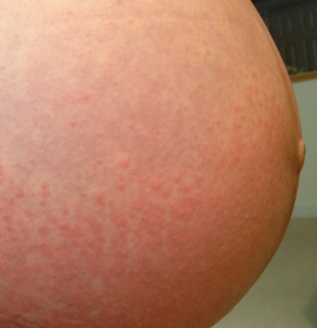 Raised Skin Bump: 31 Causes, Photos, & Treatments