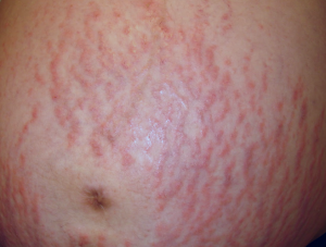 Hot Tub Rash  Pseudomonas Folliculitis - Skinsight