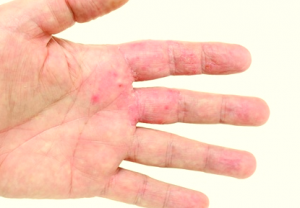 rash on hand and foot #9