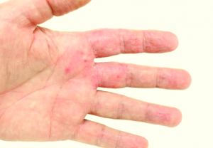 Hand Eczema - Dermatology Consultants - Skin Secrets