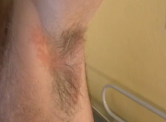 Hot Tub Rash Armpit